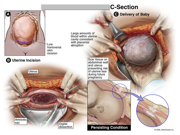 Why normal vaginal delivery is better than a cesarean section
